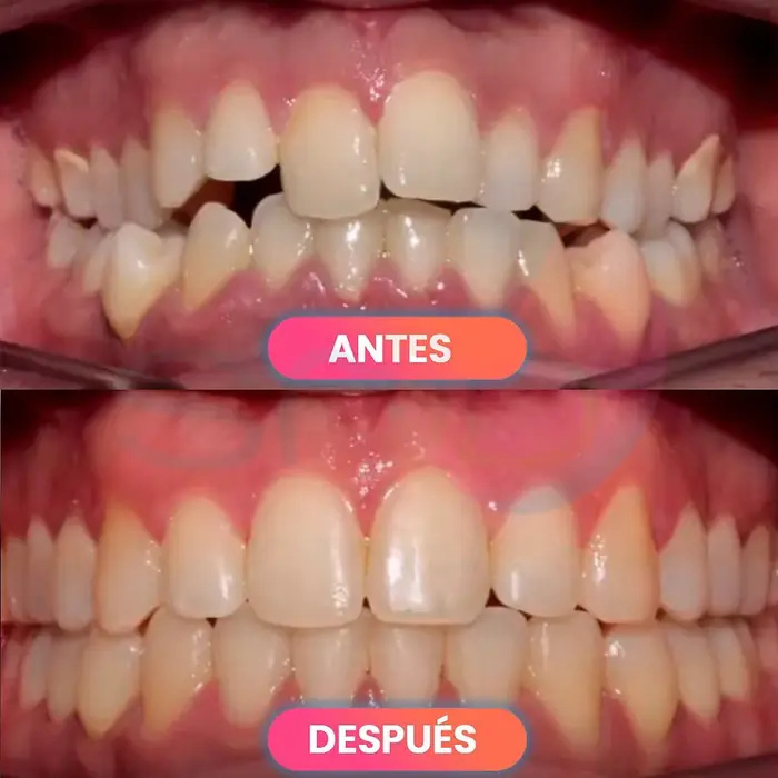 Antes y después de ortodoncia invisible, paciente real de SMD Clinic