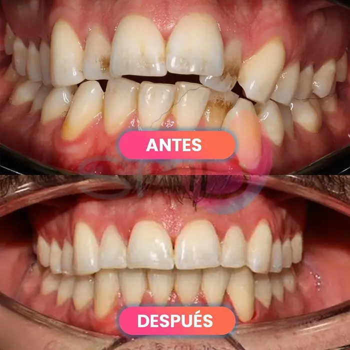 Antes y después con alineadores, paciente real de SMD Clinic