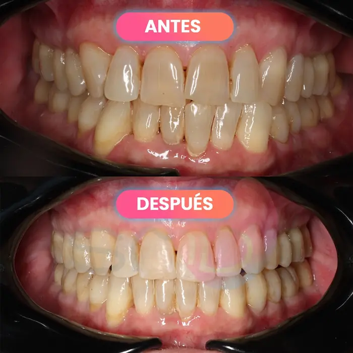 Antes y después de un blanqueamiento dental, paciente real de SMD Clinic