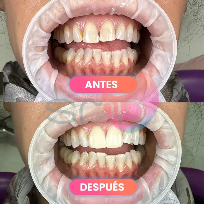 Antes y después de carillas dentales, paciente real de SMD Clinic