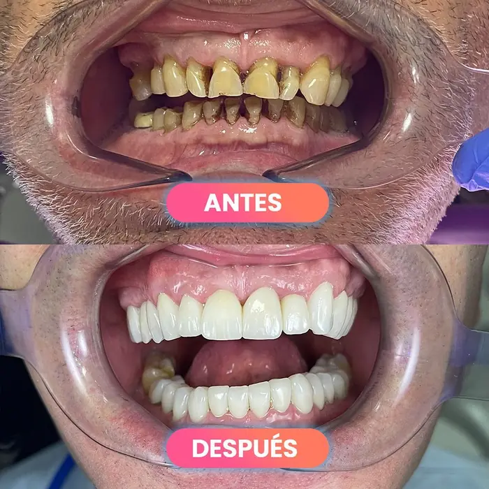 Antes y después de coronas de zirconio, paciente real de SMD Clinic