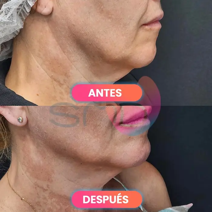 Antes y después del tratamiento de cuello y papada, paciente real de SMD Clinic