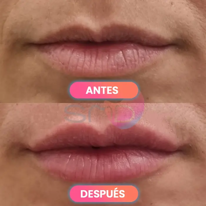 Antes y después de labios con ácido hialurónico, paciente real de SMD Clinic