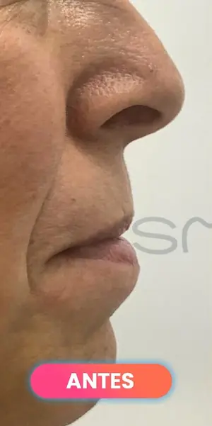 Antes: labios con ácido hialurónico vistos de perfil, paciente real de SMD Clinic