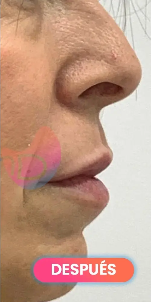 Después: labios con ácido hialurónico vistos de perfil, paciente real de SMD Clinic