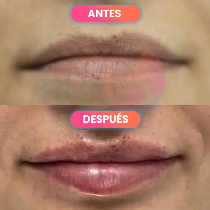 Antes y después de aumento de labios, paciente real de SMD Clinic