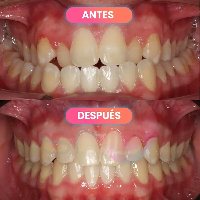 Antes y después de ortodoncia, paciente real de SMD Clinic