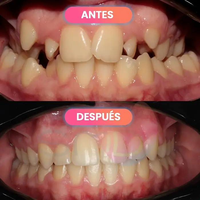 Antes y después de ortodoncia, paciente real de SMD Clinic