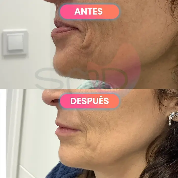 Antes y después de radiofrecuencia facial, paciente real de SMD Clinic