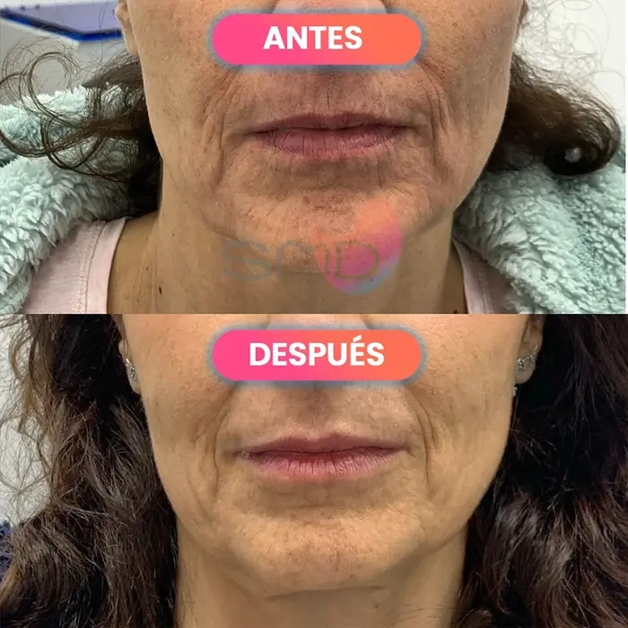 Antes y después de radiofrecuencia en el surco, paciente real de SMD Clinic