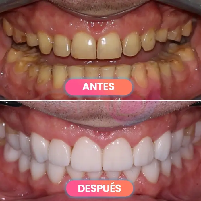 Antes y después de una rehabilitación completa, paciente real de SMD Clinic