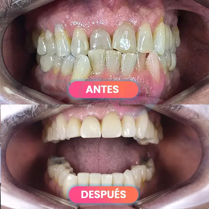 Antes y después de una rehabilitación dental, paciente real de SMD Clinic