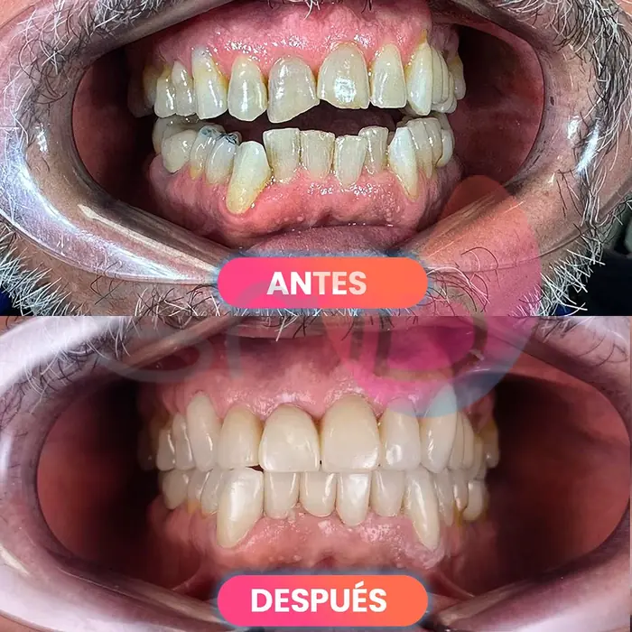 Antes y después de una rehabilitación estética, paciente real de SMD Clinic