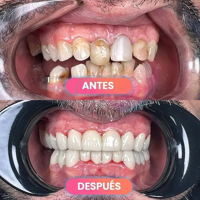 Antes y después de una rehabilitación dental con sedación consciente, paciente real de SMD Clinic