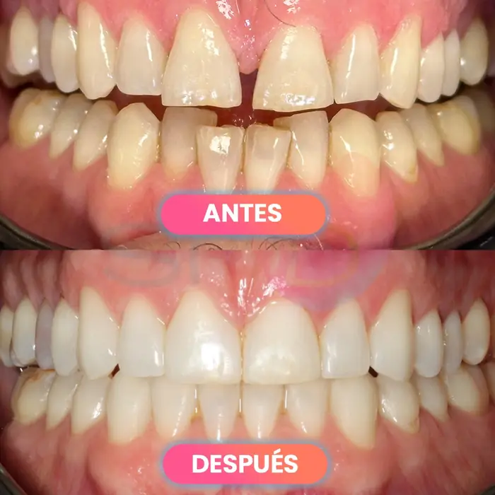 Antes y después de un rejuvenecimiento de la sonrisa, paciente real de SMD Clinic