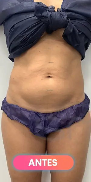 Antes: Lipoláser en abdomen, paciente real de SMD Clinic