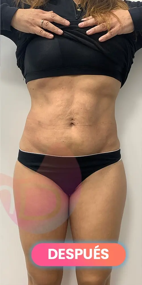 Después: Lipoláser en abdomen, paciente real de SMD Clinic