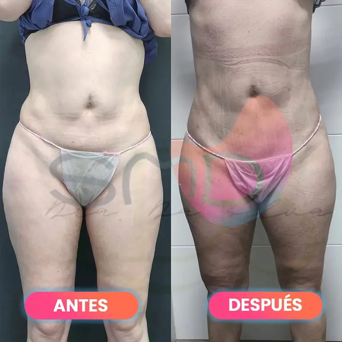 Antes y después de Smartlipo en abdomen y muslos, paciente real de SMD Clinic