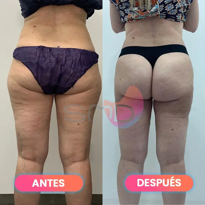 Antes y después de Smartlipo en glúteos y cartucheras, paciente real de SMD Clinic