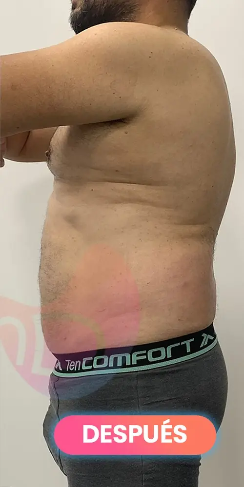 Después: Lipoláser en abdomen de un paciente, real de SMD Clinic