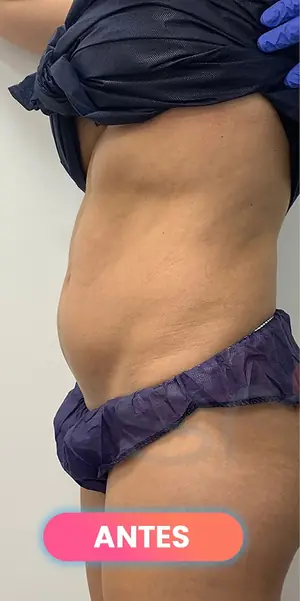 Antes: Lipoláser visto de perfil, paciente real de SMD Clinic