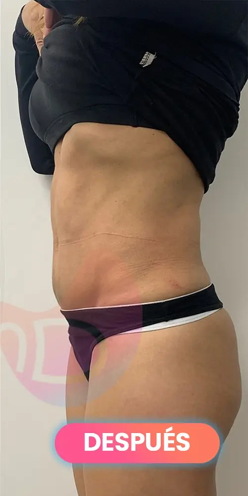 Después: Lipoláser visto de perfil, paciente real de SMD Clinic
