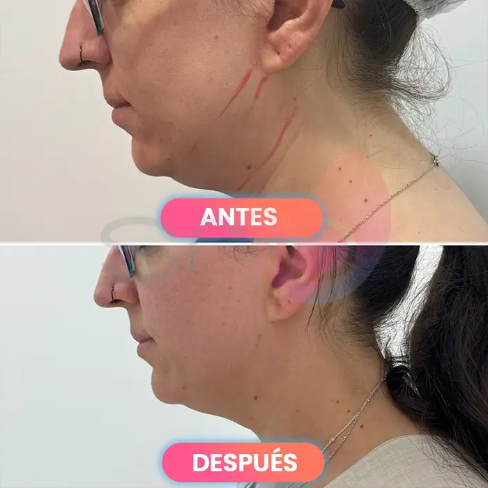 Antes y después de Smartlipo en papada, paciente real de SMD Clinic