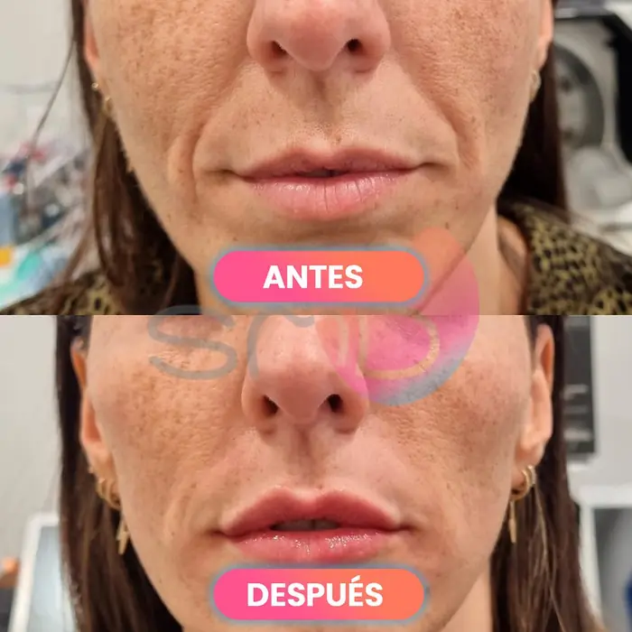 Antes y después del surco nasogeniano, paciente real de SMD Clinic