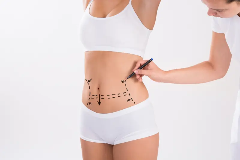 Médica marca con rotulador la zona del abdomen de una paciente antes de un tratamiento corporal