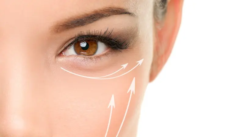 Rostro con las líneas del lifting sin cirugía