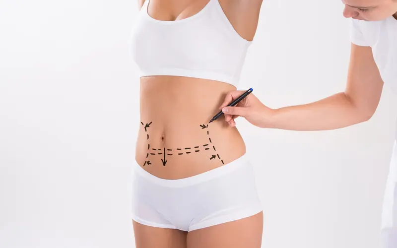 Marcado del abdomen antes de un tratamiento corporal