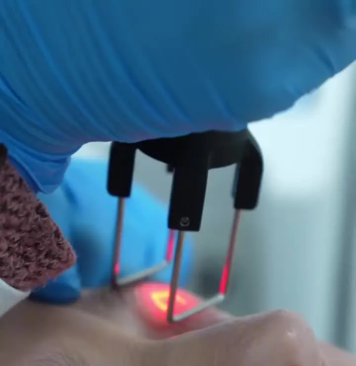 Pieza de mano del láser CO2 sobre la piel en SMD Clinic