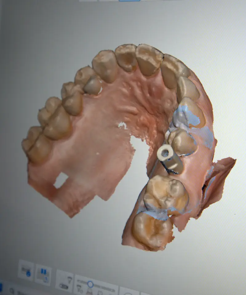 Planificación digital de implantes en la pantalla del gabinete de SMD Clinic