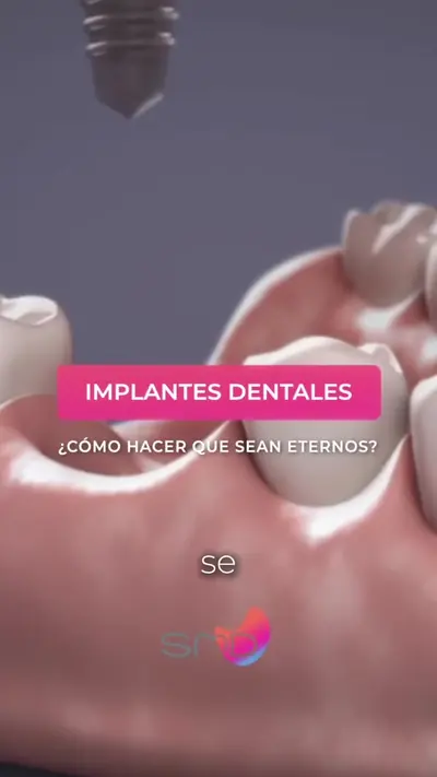 Cómo hacer que tus implantes duren, con el Dr. José Rada
