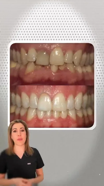 Ortodoncia invisible con la Dra. Irene Gómez Redondo